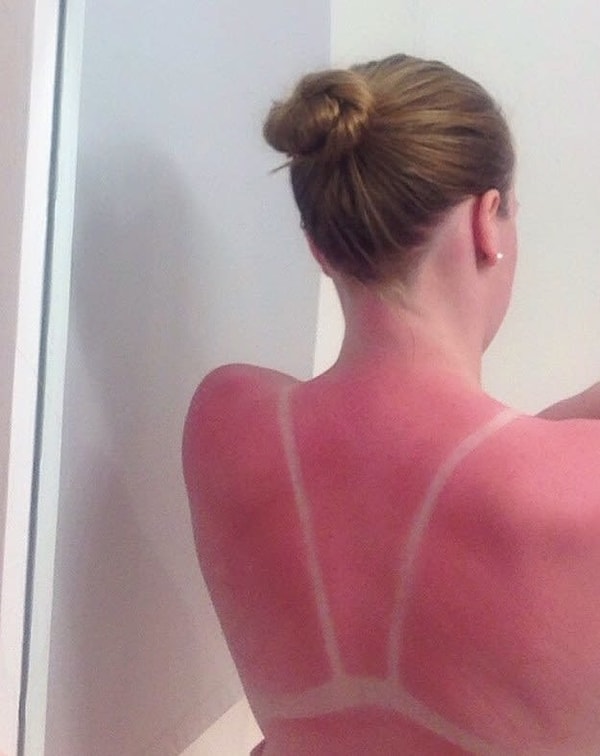 9. Боль от этого ожога буквально можно прочувствовать сквозь фото