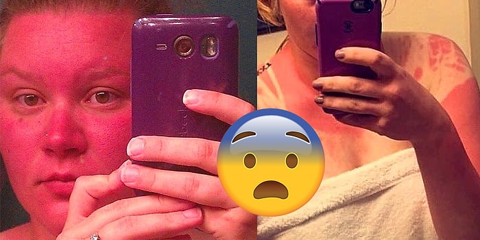 Смельчаки, которые отказались от солнцезащитного крема и моментально пожалели об этом