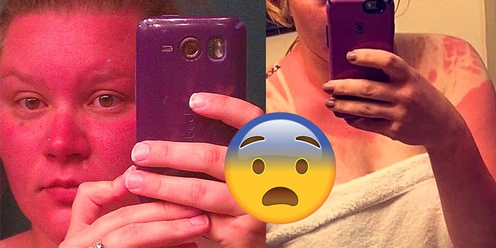 Смельчаки, которые отказались от солнцезащитного крема и моментально пожалели об этом