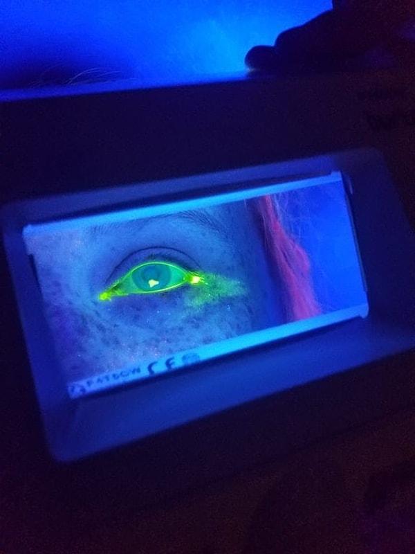 14. Gözdeki küçük çizilmelerin tespiti için oldukça saykodelik bir yöntem kullanılıyor. UV boyası göze damlatılıyor ve siyah ışıkla bakılıyor.