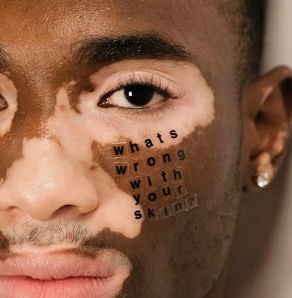 1. Фотограф Питер Де Вито учится в Технологическом институте моды в Нью-Йорке. Он ведёт Инстаграм, где регулярно публикует снимки молодых людей с особенностями кожи, такими как акне, альбинизм, витилиго, алопеция и другие. Его цель - привлечь внимание к проблеме комплексов на эту тему и дать окружающим понять, что это абсолютно нормально.