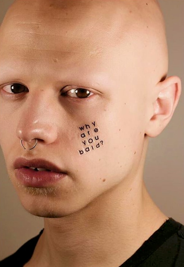 6. А у этого парня с алопецией регулярно спрашивают, почему он лысый?