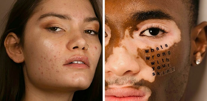 Фотограф снимает людей с особенностями кожи, чтобы показать, что все мы без исключения прекрасны