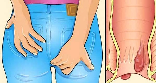 Hemeroidin belirtileri nelerdir?