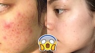 Hayrete Düşüren Bir Teori Daha: Sivilceleriniz Size Bir Şey Söylemek İstiyor Olabilir mi?