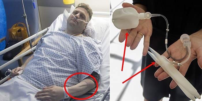 Doğuştan Sahip Olduğu Anomali Yüzünden Penisi Olmayan Adamın 50 bin Pound'luk Biyonik Penis Ameliyatı Hikayesi