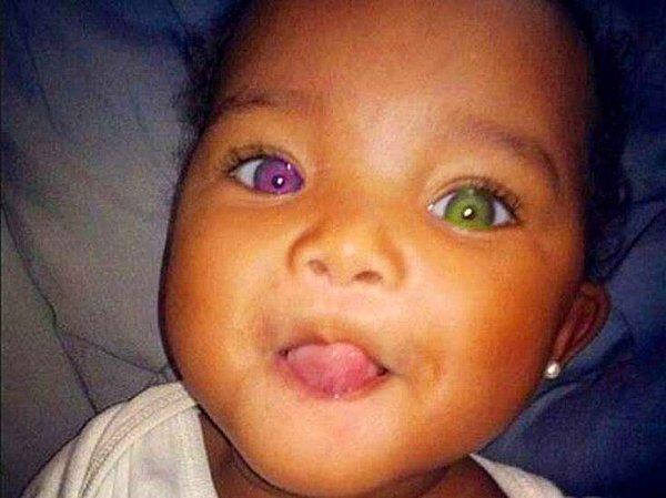 20. "Bu Afrikalı çocuğun iki farklı göz rengi var!"