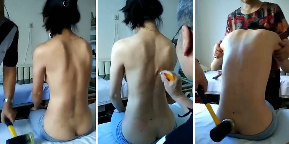 Omurga Ağrılarına Balyozla Vurarak Tedavi Yöntemi Uygulayan Doktor