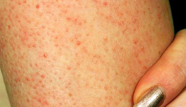 Yemek Yeme Aliskanliklarimizi Degistirerek Cilt Sorunlarimiza Care Bulabilir Miyiz Yemek Yeme Aliskanliklarimizi Degistirerek Cilt Sorunlarimiza Care Bulabilir Miyiz