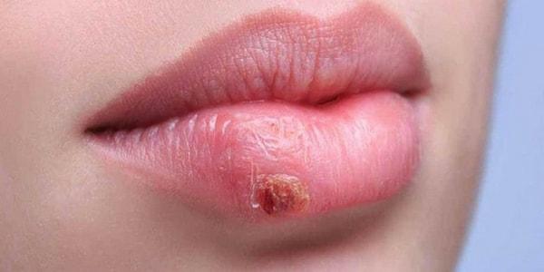 a herpes simplex okoz-e fogyást
