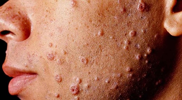 1. Передается ли половым путем сифилис?