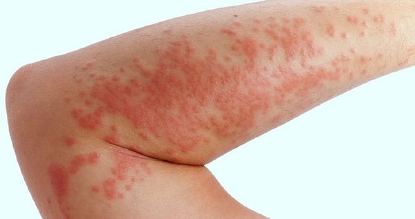 6. Передается ли половым путем экзема?