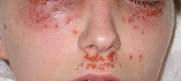 7. Передается ли половым путем генитальный герпес?