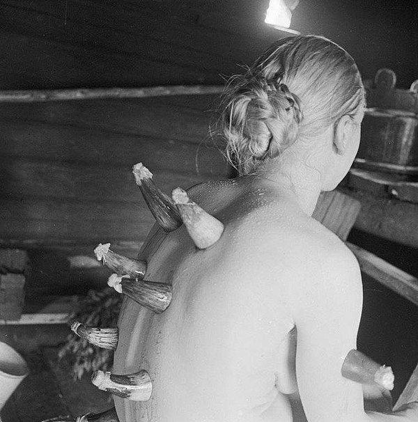 4. Boynuz çekme tedavisi- Finlandiya, 1935