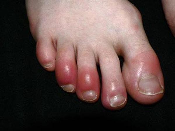 9. Şişmiş ayak parmakları
