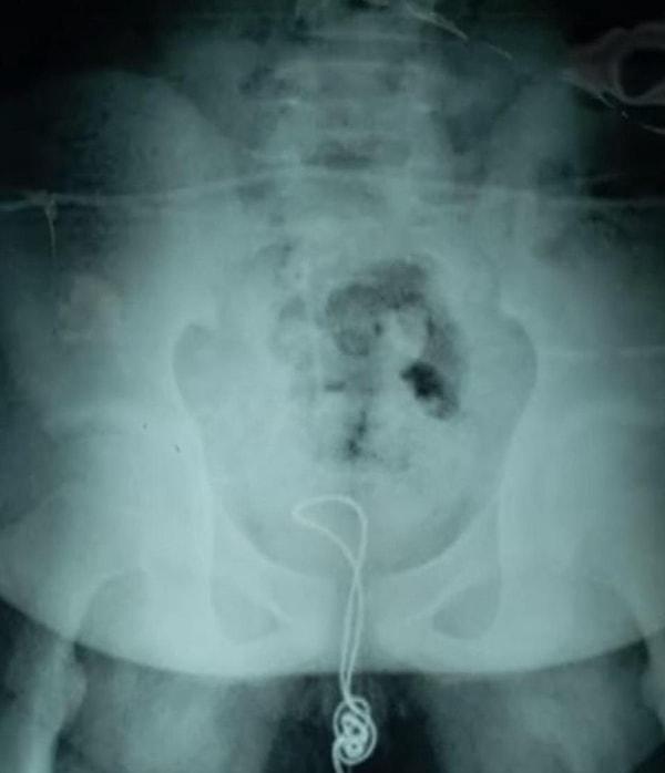 Doktorlar, çektikleri röntgen filminde kablonun çocuğun içinde düğümlendiğini fark ettiler.