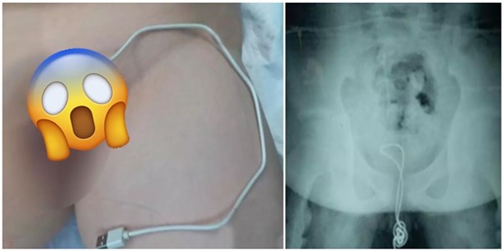 İnsanın Başına Ne Gelirse Meraktan Geliyormuş! Cinsel Organına Şarj Kablosu Sıkışan Talihsiz Çocuk