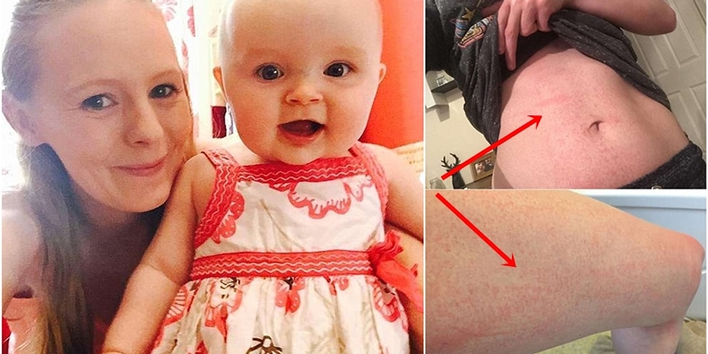 Su Bile İçemiyor! Hamilelikte Hormonların Değişmesi Nedeniyle Suya Alerjisi Başlayan Annenin Hikayesi