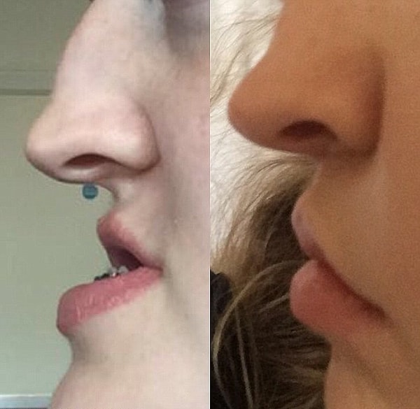 В ходе 4-часовой операции врачи выдвинули верхнюю челюсть на 7 мм вперед, а нижнюю отодвинули на 8 мм назад