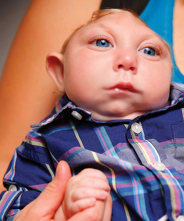 2. После многочисленных исследований удалось выяснить, что Джексон страдает микрогидроцефалией, заболеванием, которое препятствует развитию мозга.