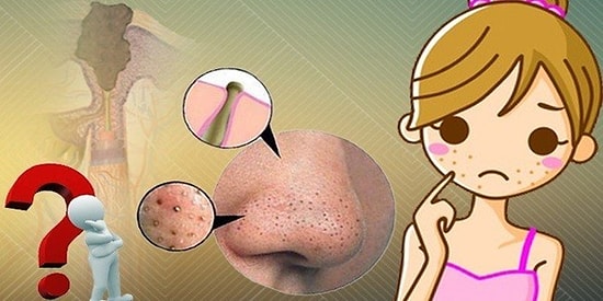 Sık Sık Nereye Kadar! Baş Belası Siyah Noktalardan Kurtulmanızı Sağlayacak 11 Doğal Maske Tarifi