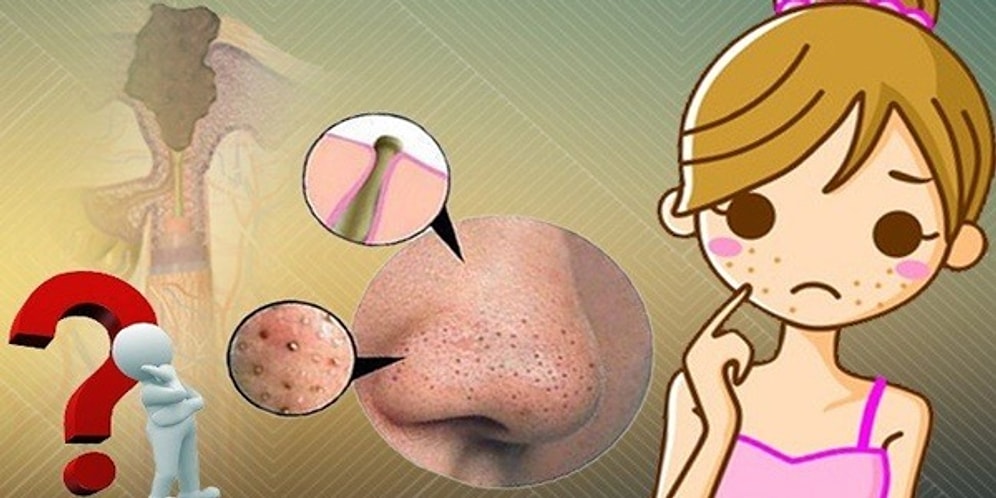 Sık Sık Nereye Kadar! Baş Belası Siyah Noktalardan Kurtulmanızı Sağlayacak 11 Doğal Maske Tarifi