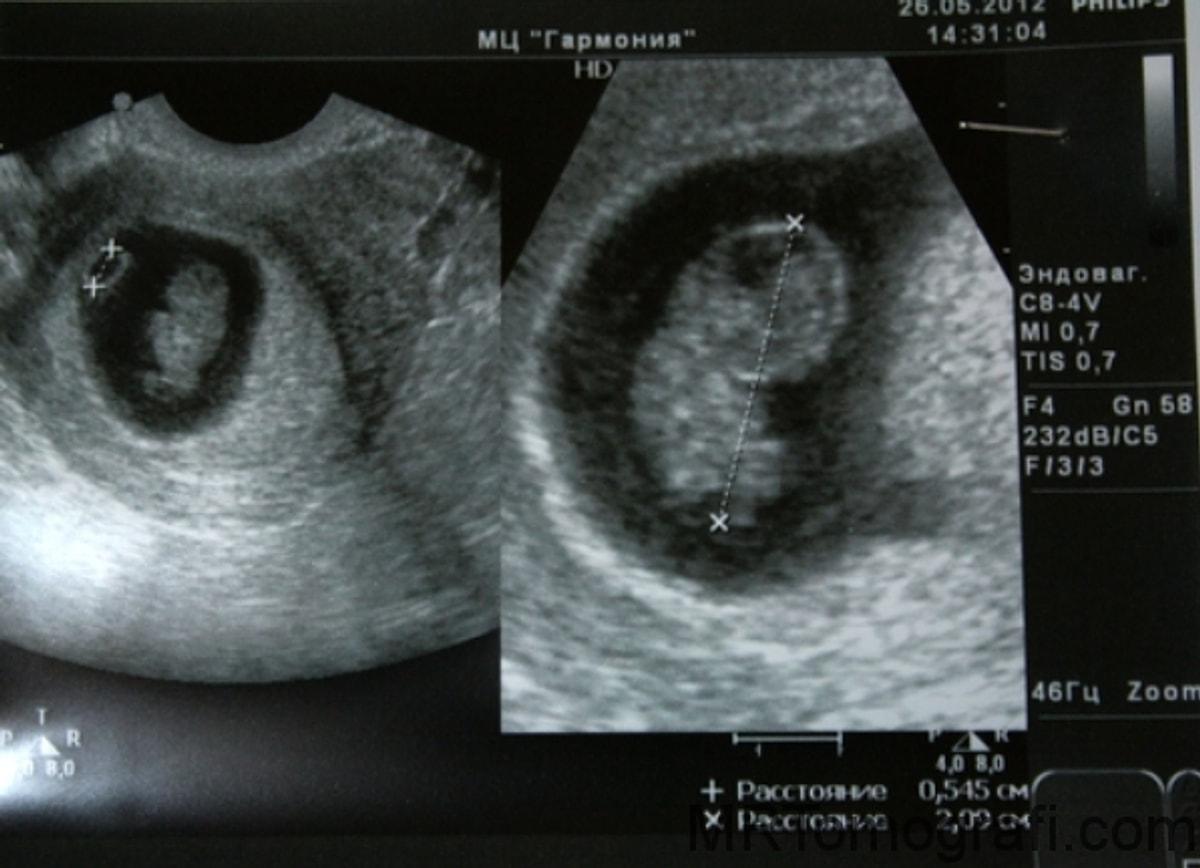 На 8 неделе на данном. УЗИ на 8 неделе беременности акушерской. 8 Недель беременности фото плода на УЗИ. УЗИ на 7-8 акушерской неделе беременности. Эмбрион на 8 неделе беременности УЗИ.