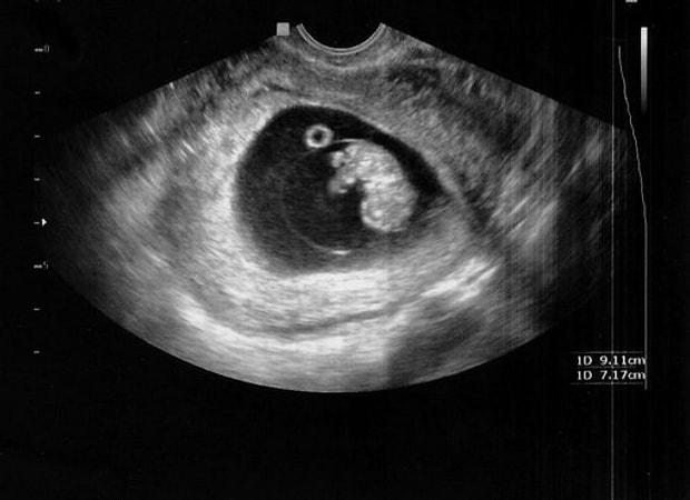 hamilelikte 9 hafta bebek artik kollarini ve bacaklarini hareket ettirebiliyor