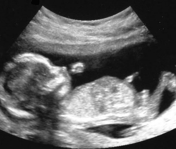 Bebeğin cinsel organı 14. haftada gelişimini tamamlamıştır.