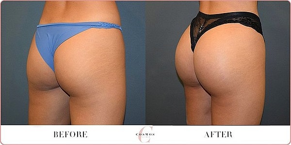 Пластика ягодиц!