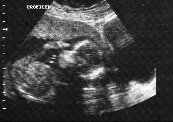 17. Мы начинаем видеть сны еще в утробе матери