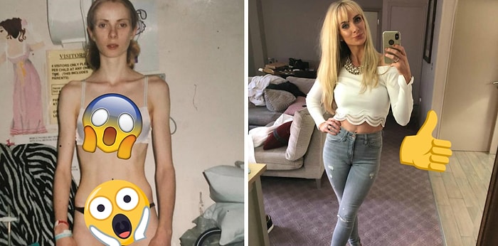 Анорексичка, которой была впору только детская одежда, смогла избежать смерти, захотев стать мамой