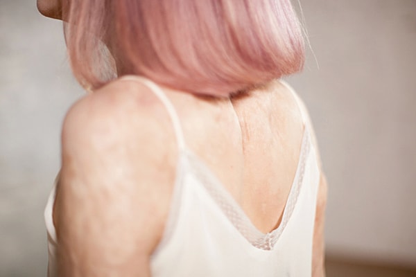 9. "Мое детство в Комсомольск-на-Амуре было тяжелым из-за многочисленных издевательств и насмешек по поводу моих ожогов", - признается Света.