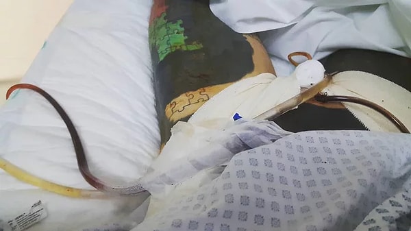 7. Чтобы удалить гениталии, Керликалу пришлось отправиться в Мексику, где в больнице города Гвадалахара ему и провели операцию.