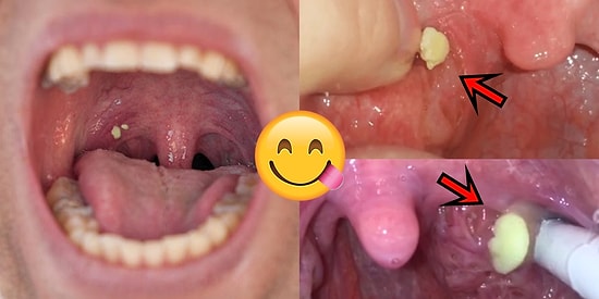 Sivilce Sıkma Videolarından Sonra Aynı Zevki Veren Yeni Trend: Bademcik Taşı Çıkarma