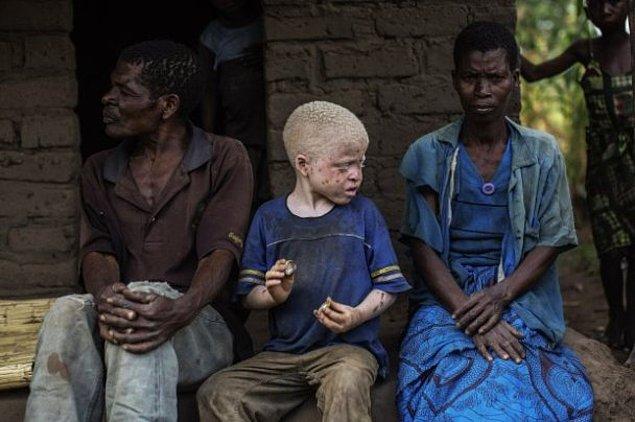 Albino bireylerin gözlerinde yüksek oranda görme bozukluğu ve astigmat mevcut.