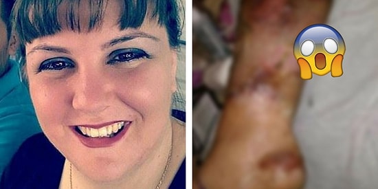 Pedikür Yaptırırken Nasırlarını Kestirdiği İçin Bacağını Kaybetme Tehlikesiyle Karşı Karşıya Kalan Kadın