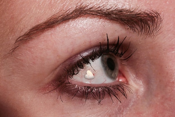 5. Эмиль Чинн говорит, что процедура безболезненная и заживление происходит всего за три дня.