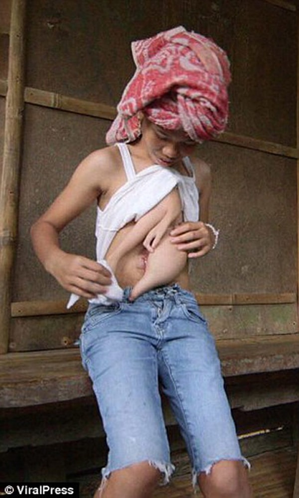 6. На пальцах близнеца-паразита девочки растут ногти, а из-под нароста временами сочится кровь и исходит дурной запах, как от человеческих экскрементов.