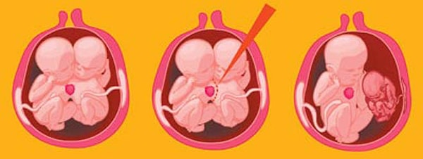 5. Однако оказалось, что на ранних стадиях эмбрионального развития зародыш Вероники поглотил другого ребенка.