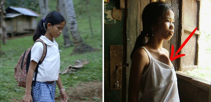 Девочке с шестью конечностями удалят близнеца-паразита, торчащего у нее из торса