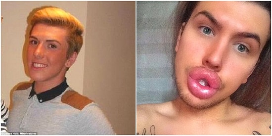 Парень помешан на пластических операциях: родители боятся, что губы их сына однажды не выдержат и лопнут (или "отвалятся")