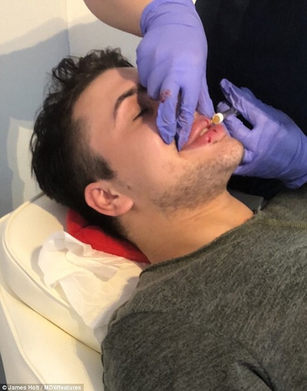 Но и это еще не всё. Недавно Джеймс перенес операцию по увеличению спины и в ближайшее время планирует подкорректировать свой нос еще раз.