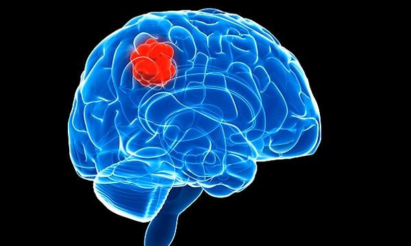 Beyin tümörü beyninizde bir kitlenin veya anormal hücrelerin büyümesidir.