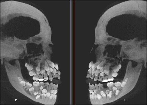 4. Çoklu hiperdontinin bulunduğu bir kişinin röntgen filmi.