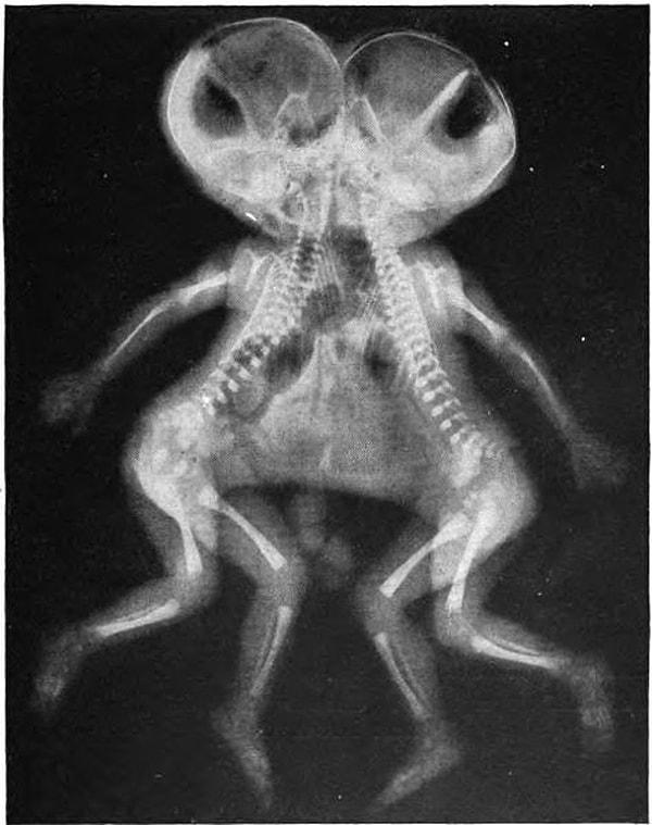 15. Yapışık ikizlerin röntgeni.