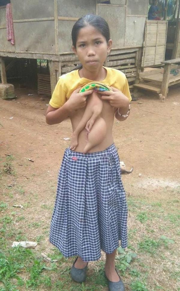 Taylandlı Veronica'nın göğsünde büyüyen parazit bir ikizi var. Genç kızın vücudu içindeki ikizinin kolları ve parmakları, göğsünden görünüyor.