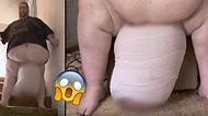 Devasa Lenf Ödemi Nedeniyle Testisleri 31 Kiloya Ulaştığı İçin 9 Yıl Boyunca Seks Yapamayan Adam
