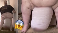Devasa Lenf Ödemi Nedeniyle Testisleri 31 Kiloya Ulaştığı İçin 9 Yıl Boyunca Seks Yapamayan Adam