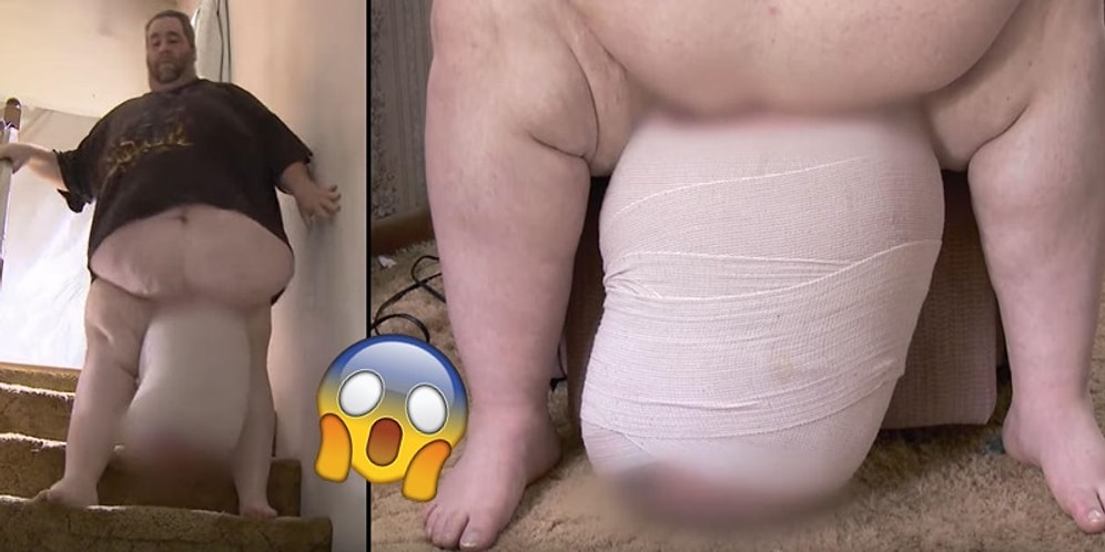 Devasa Lenf Ödemi Nedeniyle Testisleri 31 Kiloya Ulaştığı İçin 9 Yıl Boyunca Seks Yapamayan Adam